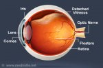 vitreous-detachment.jpg