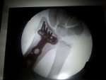 Wrist repair 1.jpg